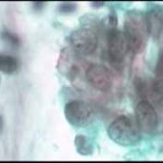 Ομάδα αδενικών κυτταρων ενδοτραχήλου. Χρώση με Cytocolor, μεγέθυνση 10Χ40